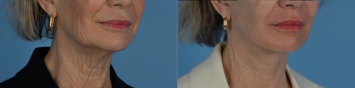Before & After Facelift/Neck Lift Case 331 Right Oblique View in Toronto, ON