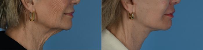 Before & After Facelift/Neck Lift Case 331 Right Side View in Toronto, ON
