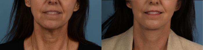 Before & After Facelift/Neck Lift Case 332 Front View in Toronto, ON