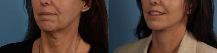 Before & After Facelift/Neck Lift Case 332 Left Oblique View in Toronto, ON