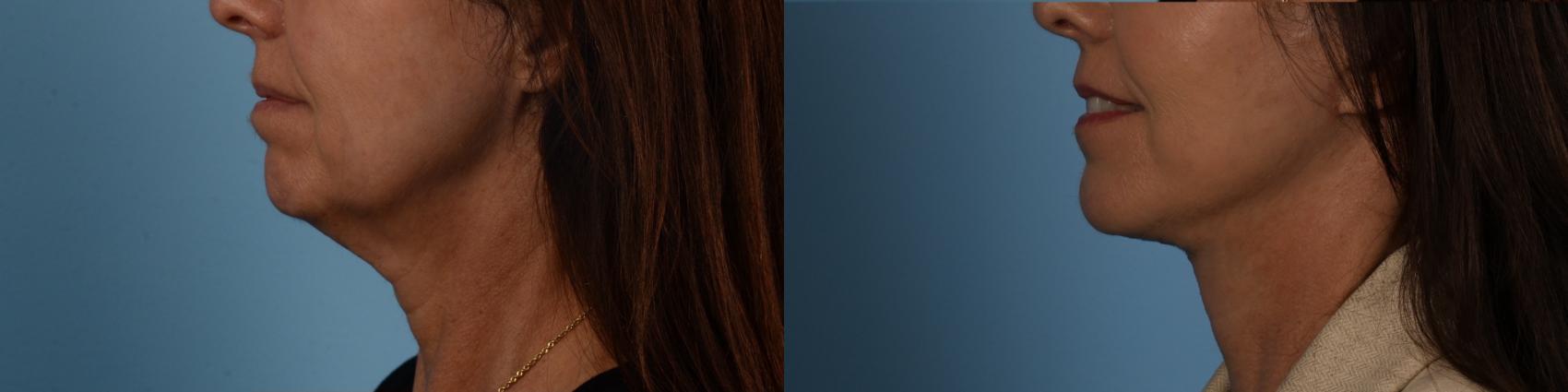 Before & After Facelift/Neck Lift Case 332 Left Side View in Toronto, ON