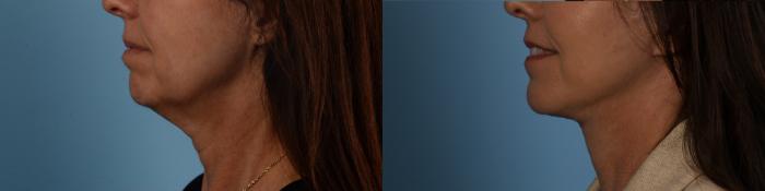 Before & After Facelift/Neck Lift Case 332 Left Side View in Toronto, ON