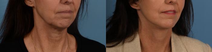 Before & After Facelift/Neck Lift Case 332 Right Oblique View in Toronto, ON
