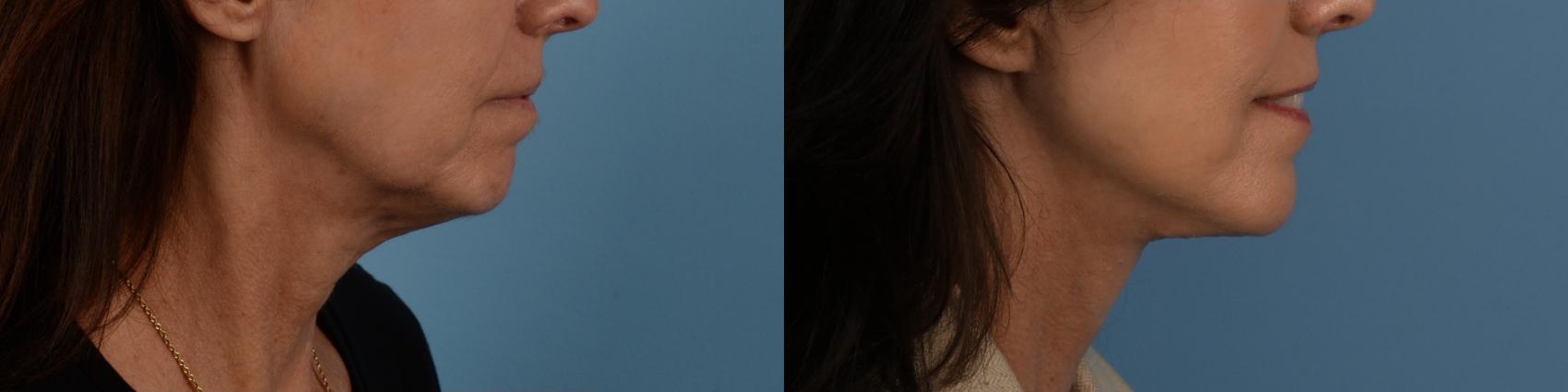 Before & After Facelift/Neck Lift Case 332 Right Side View in Toronto, ON