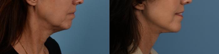 Before & After Facelift/Neck Lift Case 332 Right Side View in Toronto, ON