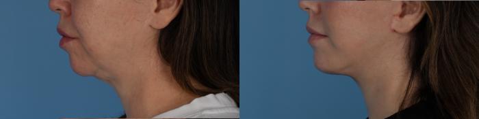 Before & After Facelift/Neck Lift Case 334 Left Side View in Toronto, ON