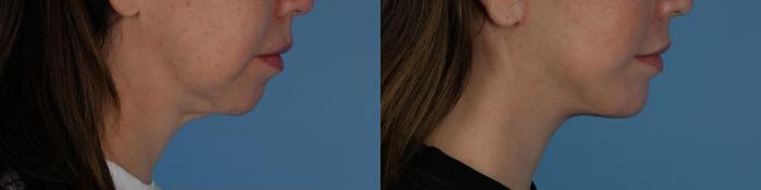 Before & After Facelift/Neck Lift Case 334 Right Side View in Toronto, ON