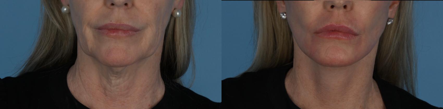 Before & After Facelift/Neck Lift Case 338 Front View in Toronto, ON