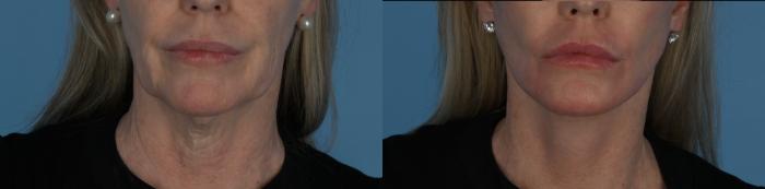 Before & After Facelift/Neck Lift Case 338 Front View in Toronto, ON