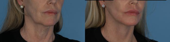 Before & After Facelift/Neck Lift Case 338 Left Oblique View in Toronto, ON