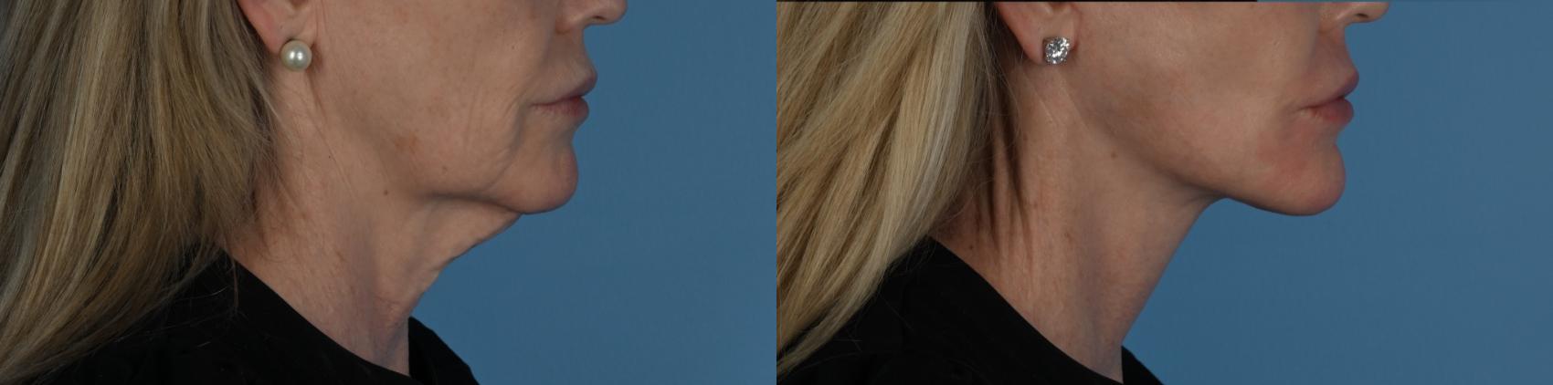 Before & After Facelift/Neck Lift Case 338 Left Side View in Toronto, ON