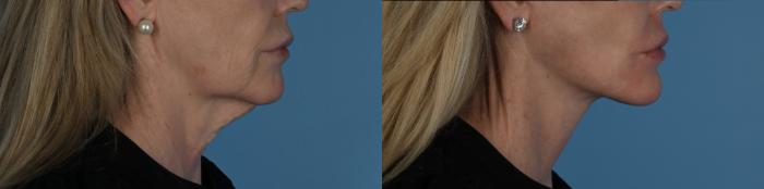 Before & After Facelift/Neck Lift Case 338 Left Side View in Toronto, ON