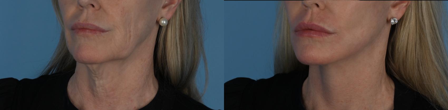 Before & After Facelift/Neck Lift Case 338 Right Oblique View in Toronto, ON