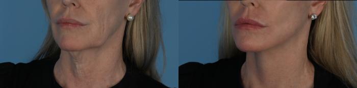 Before & After Facelift/Neck Lift Case 338 Right Oblique View in Toronto, ON