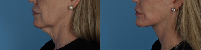 Before & After Facelift/Neck Lift Case 338 Right Side View in Toronto, ON