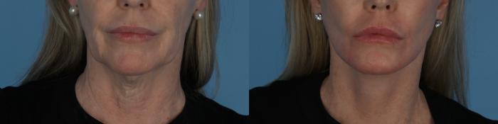 Before & After Facelift/Neck Lift Case 340 Front View in Toronto, ON
