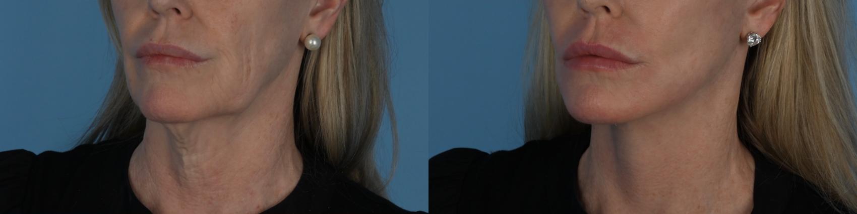 Before & After Facelift/Neck Lift Case 340 Left Oblique View in Toronto, ON