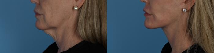 Before & After Facelift/Neck Lift Case 340 Left Side View in Toronto, ON