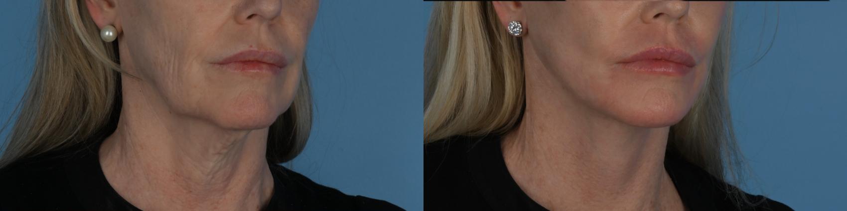 Before & After Facelift/Neck Lift Case 340 Right Oblique View in Toronto, ON