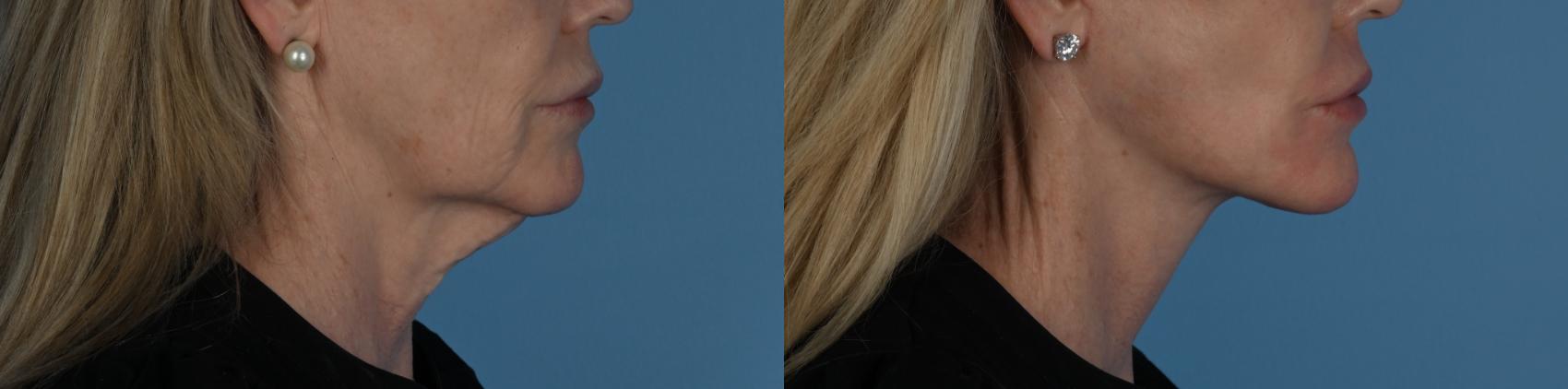 Before & After Facelift/Neck Lift Case 340 Right Side View in Toronto, ON