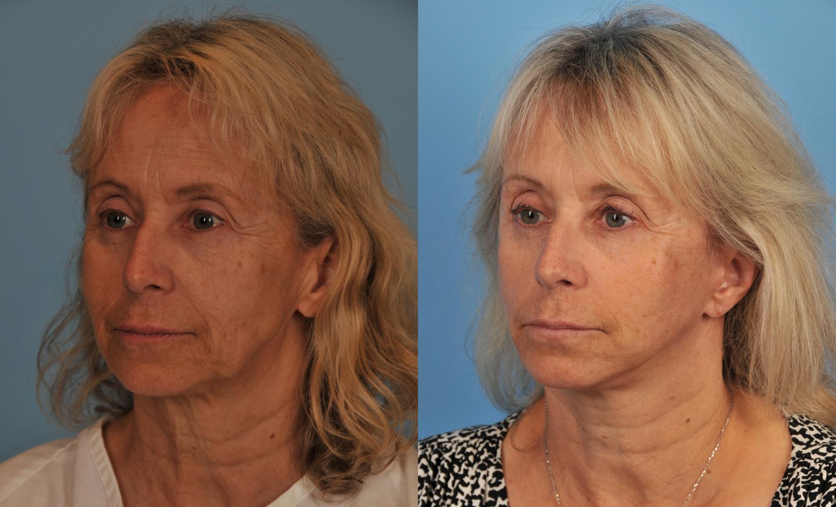 Before & After Facelift/Neck Lift Case 39 View #1 View in Toronto, ON