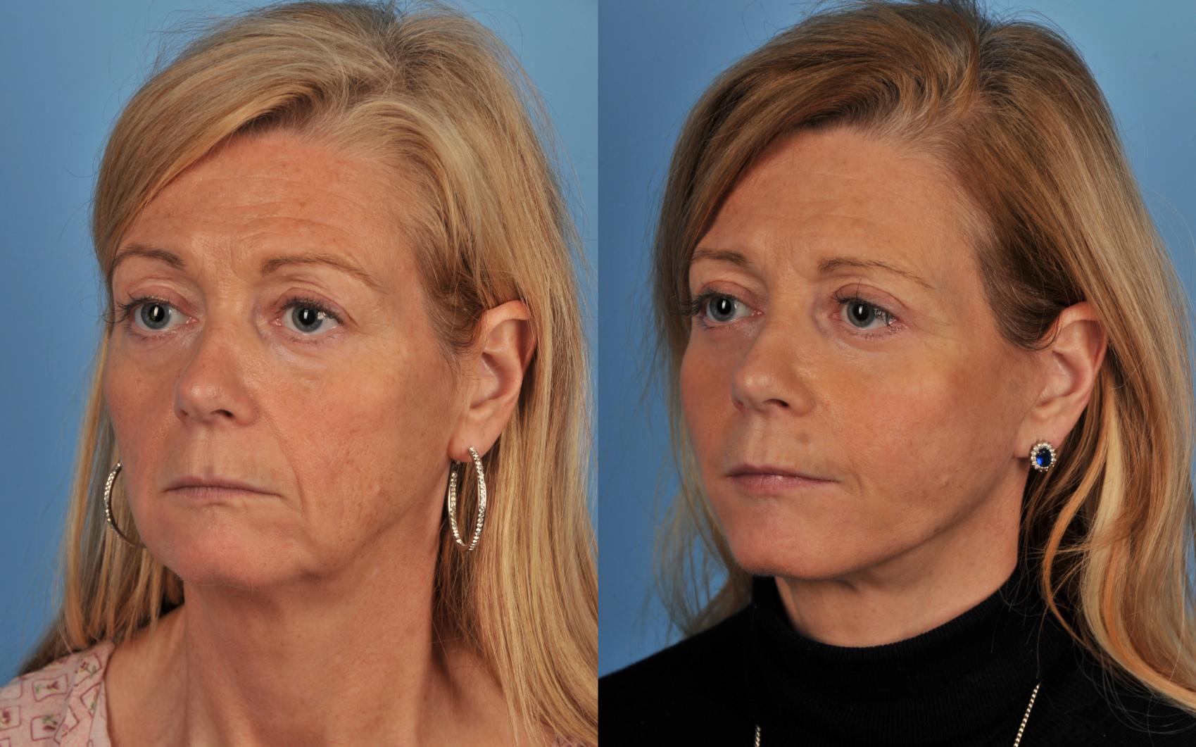 Before & After Facelift/Neck Lift Case 46 View #1 View in Toronto, ON
