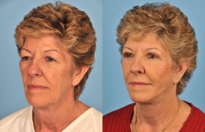 Before & After Facelift/Neck Lift Case 49 View #1 View in Toronto, ON