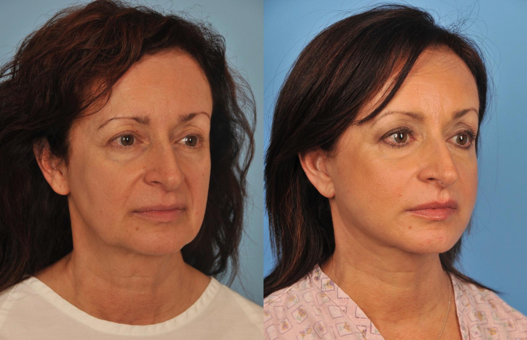 Before & After Facelift/Neck Lift Case 50 View #1 View in Toronto, ON