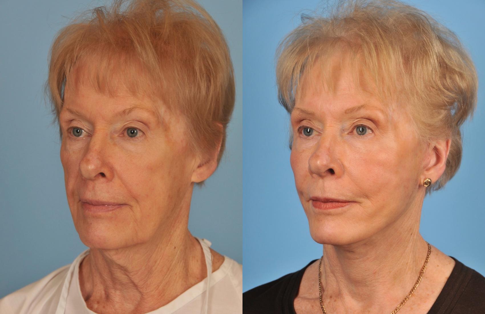 Before & After Facelift/Neck Lift Case 51 View #1 View in Toronto, ON