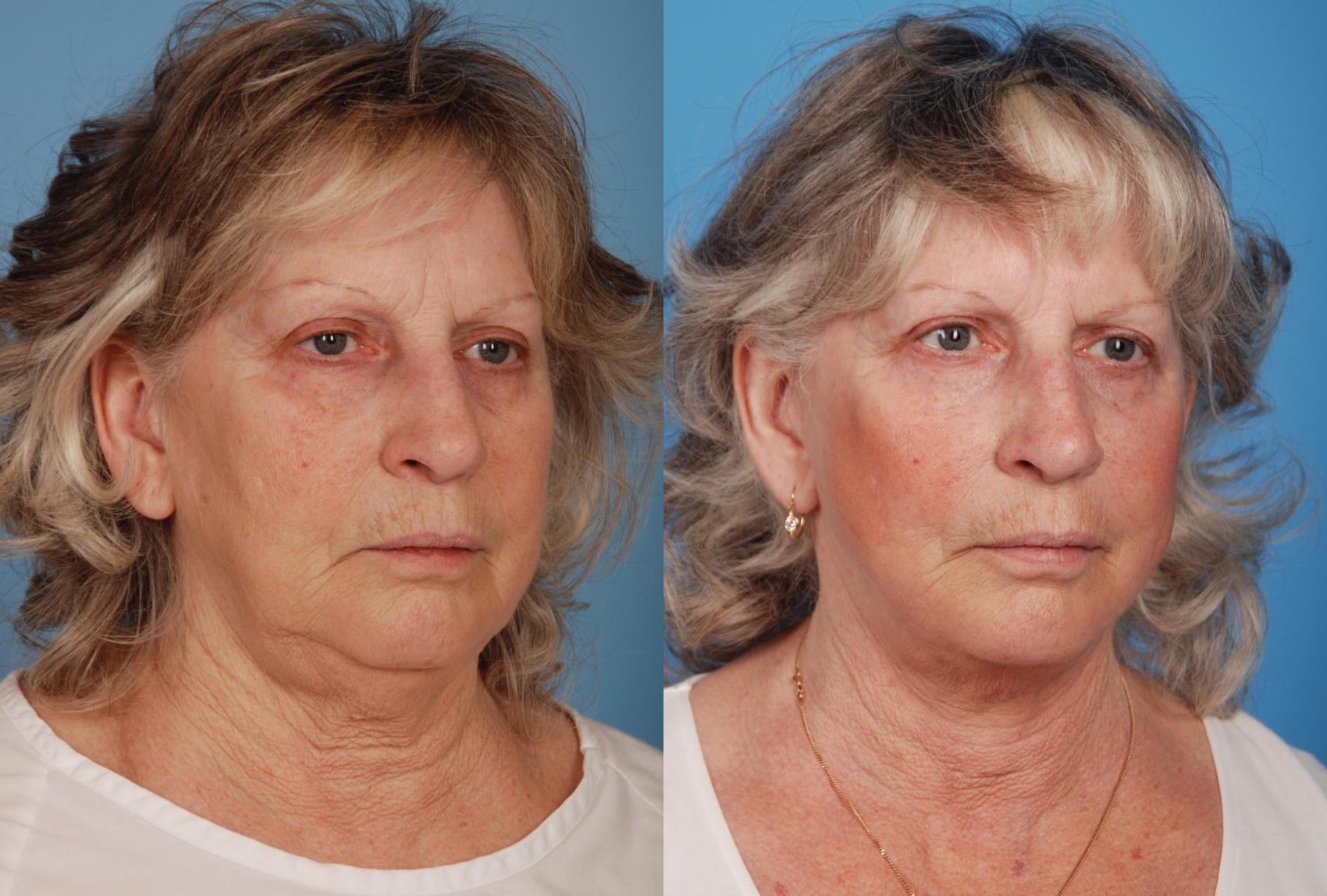 Before & After Facelift/Neck Lift Case 52 View #1 View in Toronto, ON