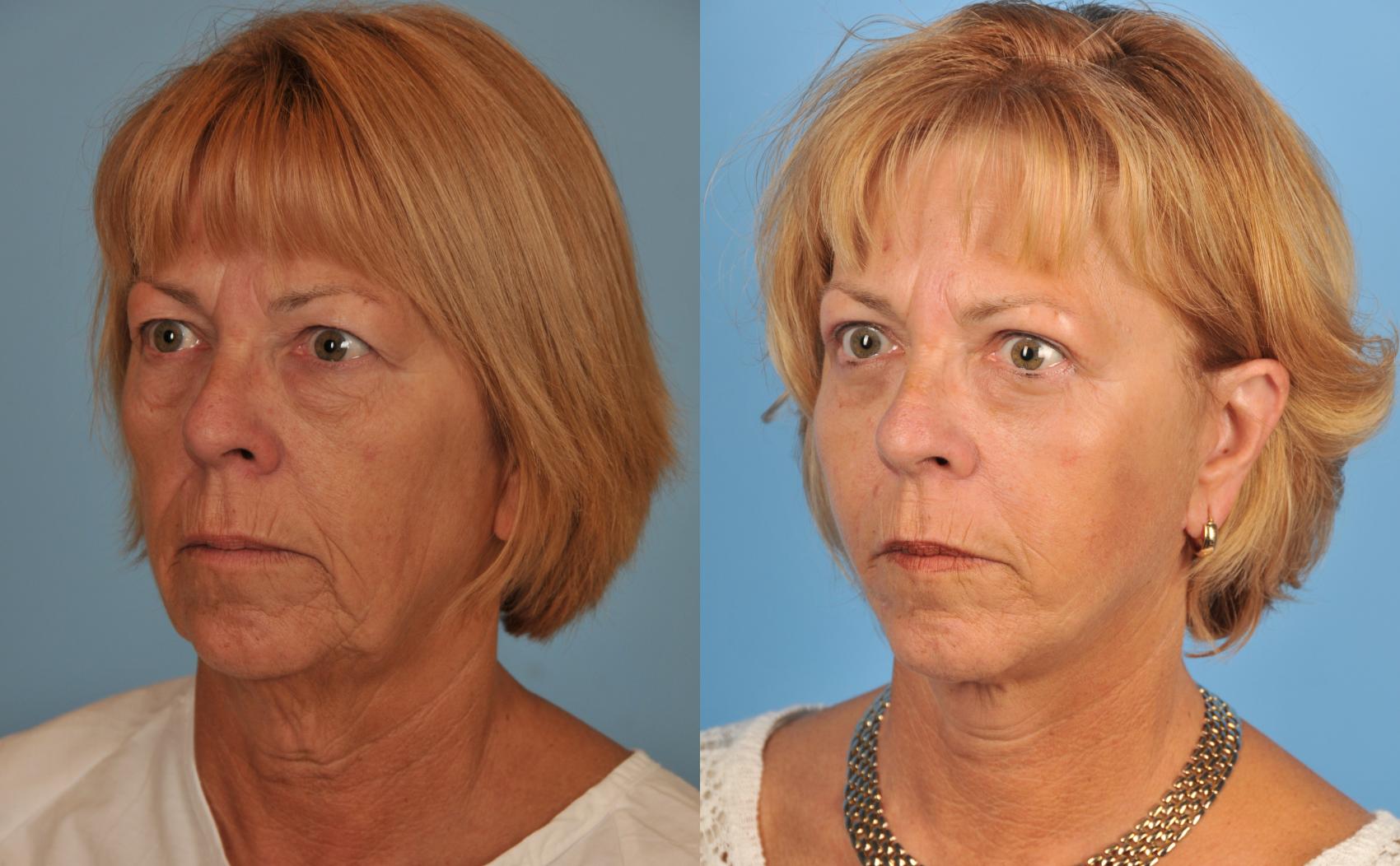 Before & After Facelift/Neck Lift Case 63 View #1 View in Toronto, ON