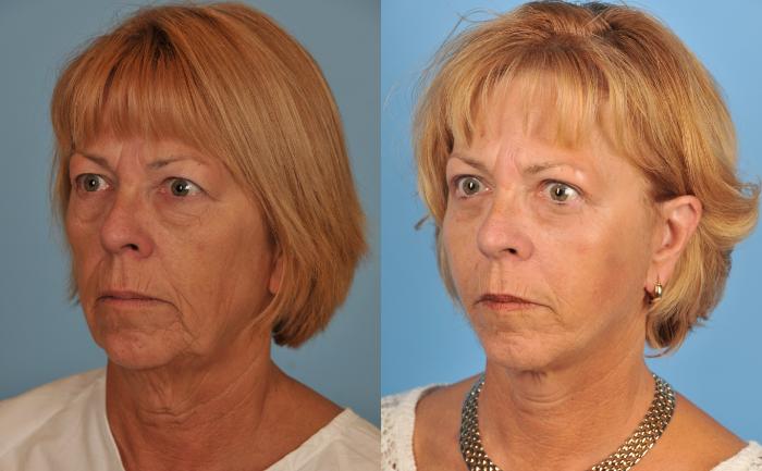 Before & After Facelift/Neck Lift Case 63 View #1 View in Toronto, ON