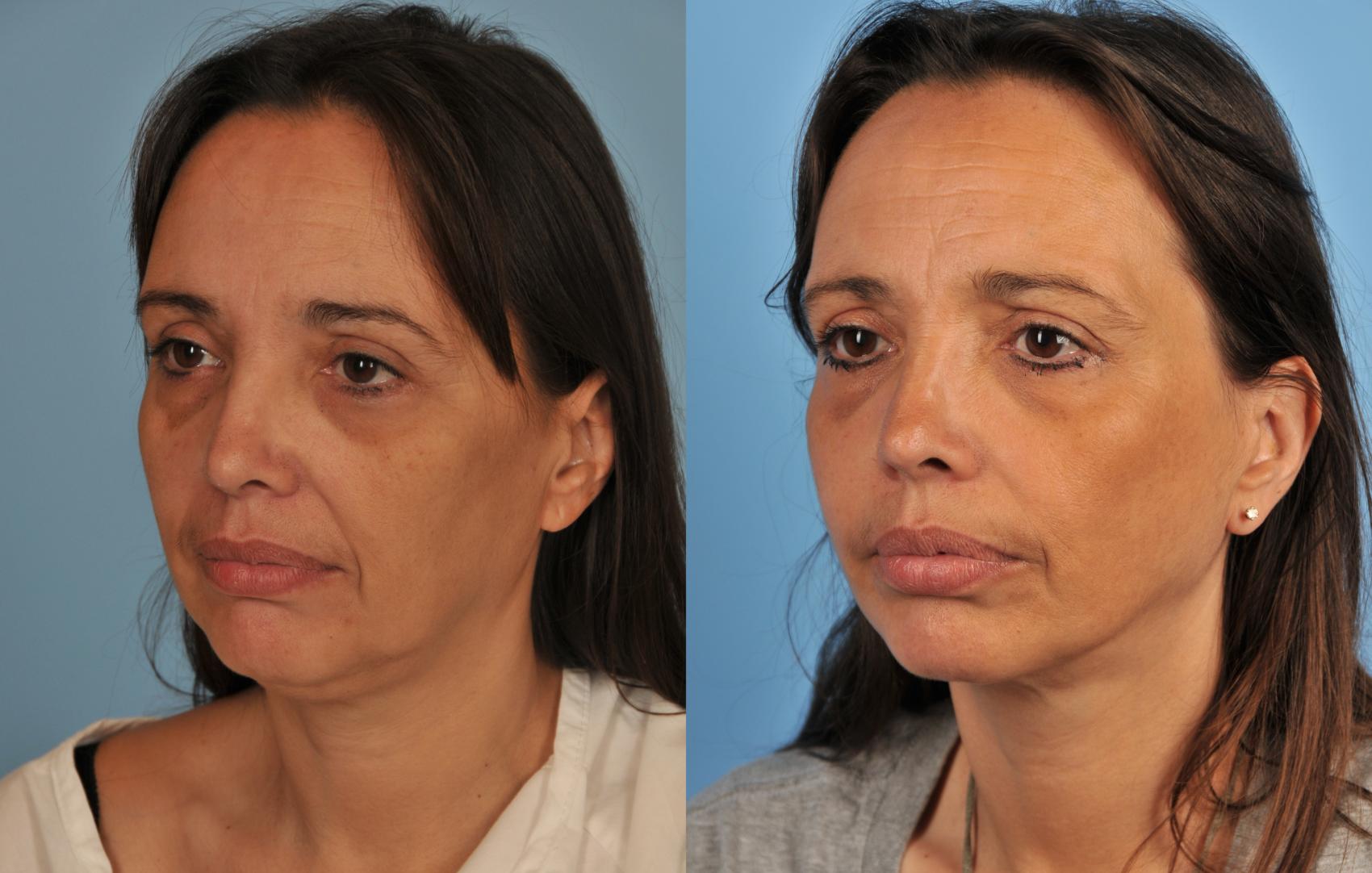 Before & After Facelift/Neck Lift Case 89 View #1 View in Toronto, ON