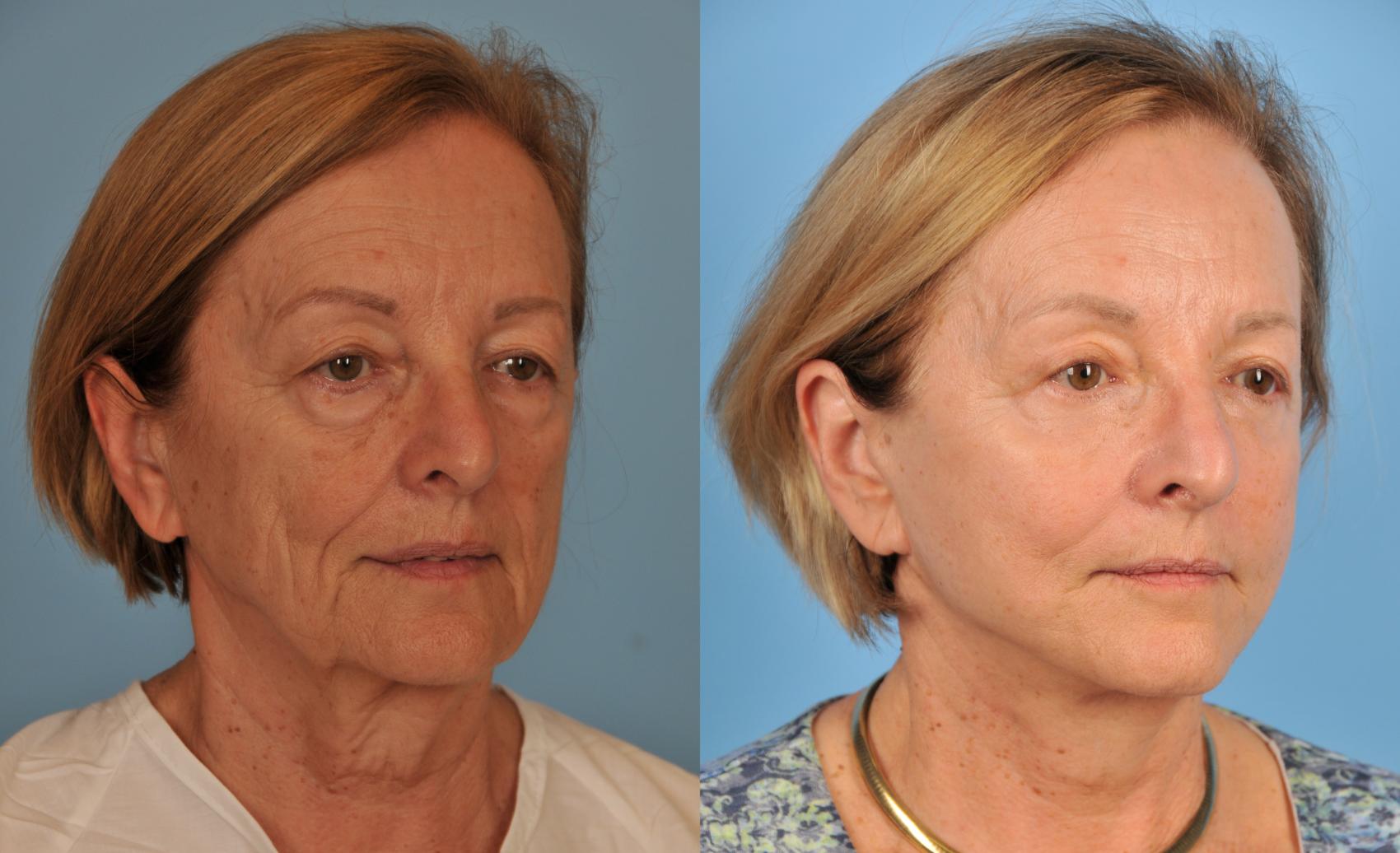 Before & After Facelift/Neck Lift Case 95 View #1 View in Toronto, ON