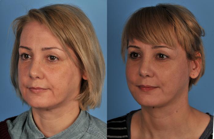 Before & After Facelift/Neck Lift Case 97 View #1 View in Toronto, ON