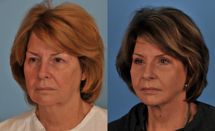 Before & After Facelift/Neck Lift Case 98 View #1 View in Toronto, ON