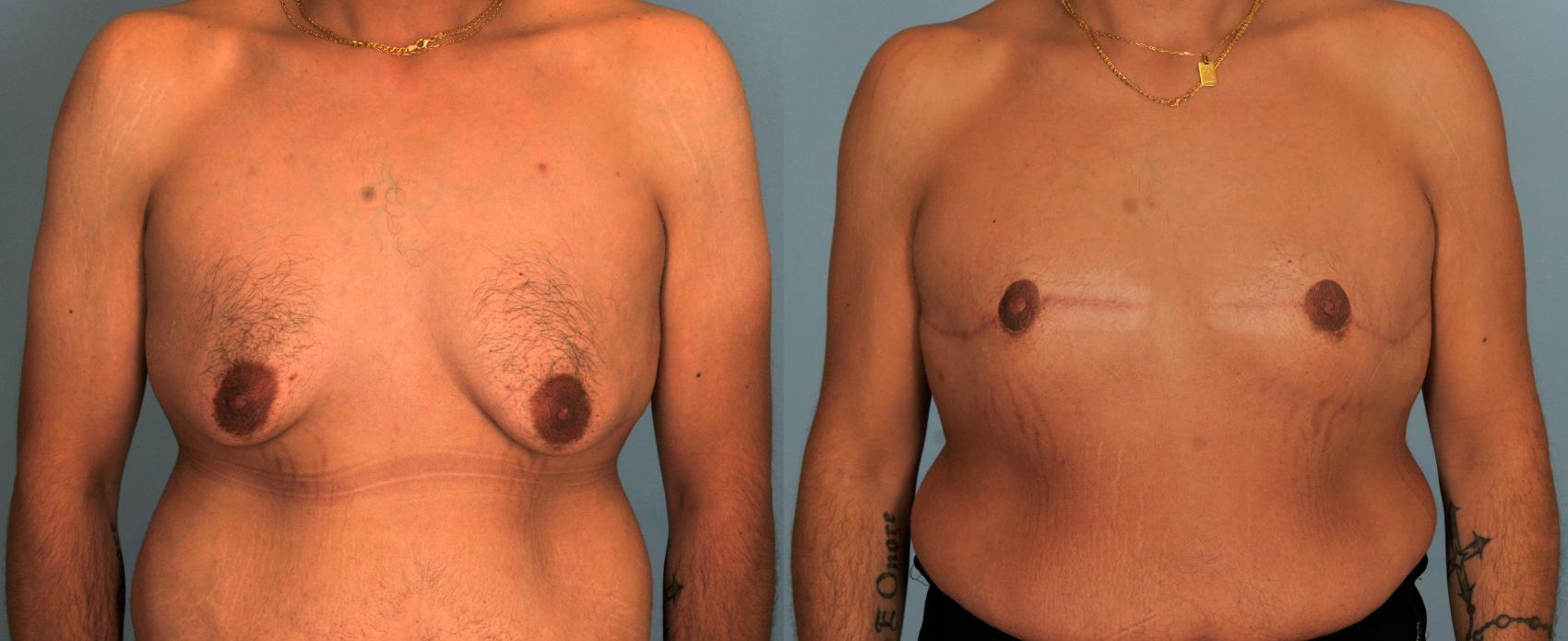 Before & After Gynecomastia Case 123 View #1 View in Toronto, ON