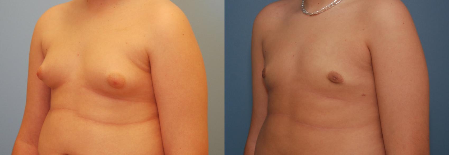 Before & After Gynecomastia Case 191 View #1 View in Toronto, ON