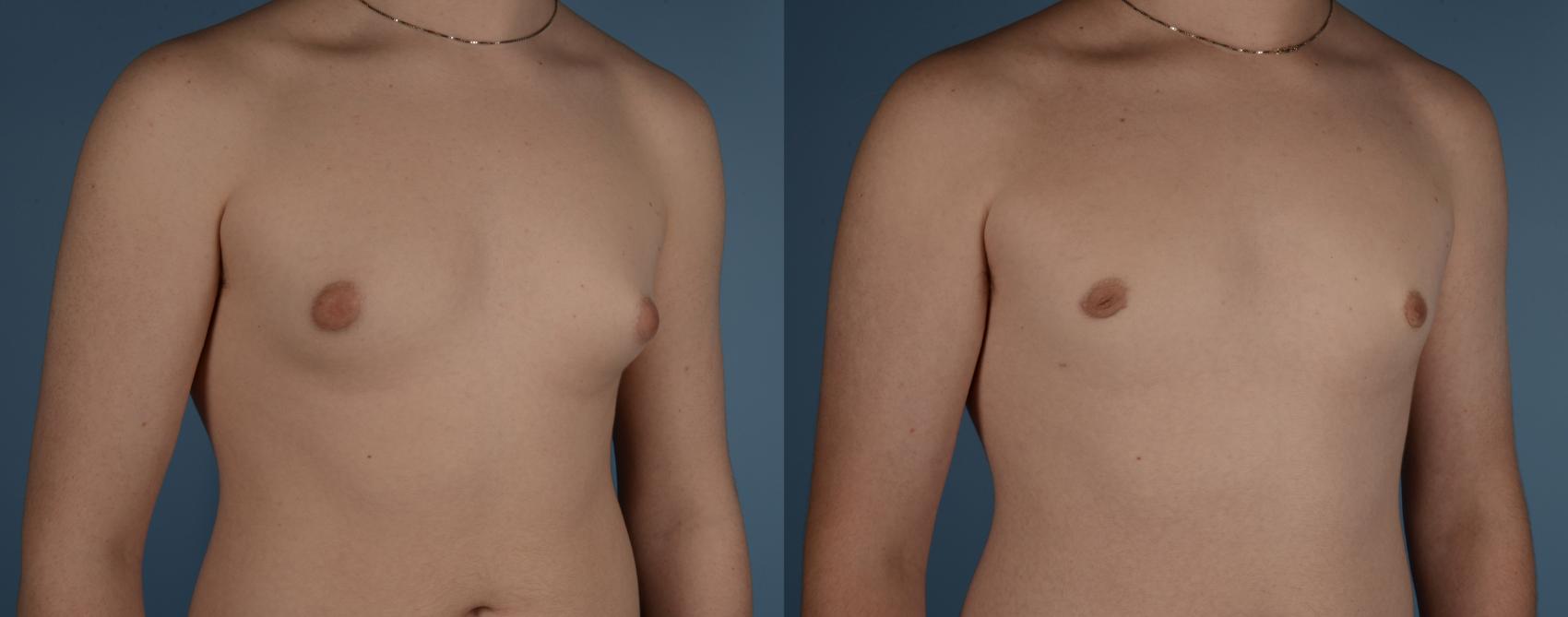 Before & After Gynecomastia Case 221 View #1 View in Toronto, ON