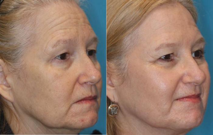 Before & After HALO® Laser Skin Resurfacing Case 246 Right Side View in Toronto, ON