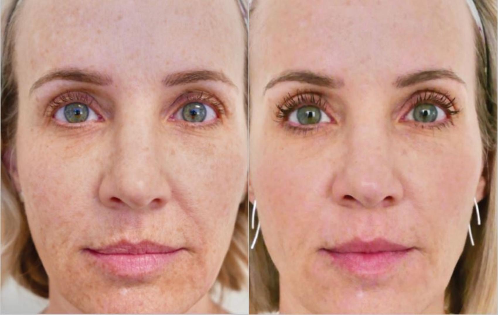 Before & After BBL® Laser Skin Rejuvenation Case 248 Front View in Toronto, ON