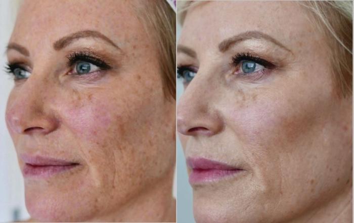 Before & After BBL® Laser Skin Rejuvenation Case 249 Left Oblique View in Toronto, ON