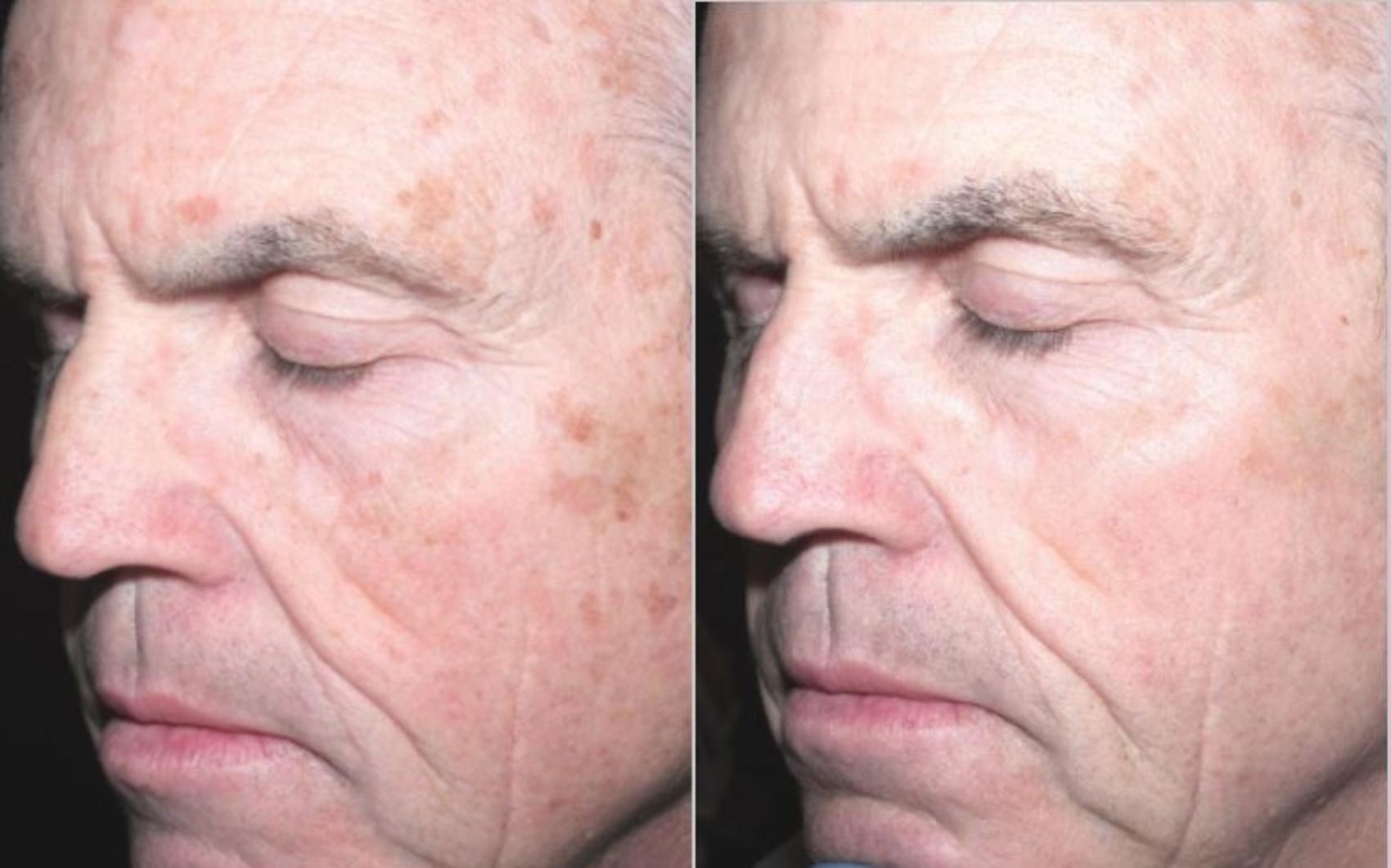 Before & After HALO® Laser Skin Resurfacing Case 253 Left Oblique View in Toronto, ON