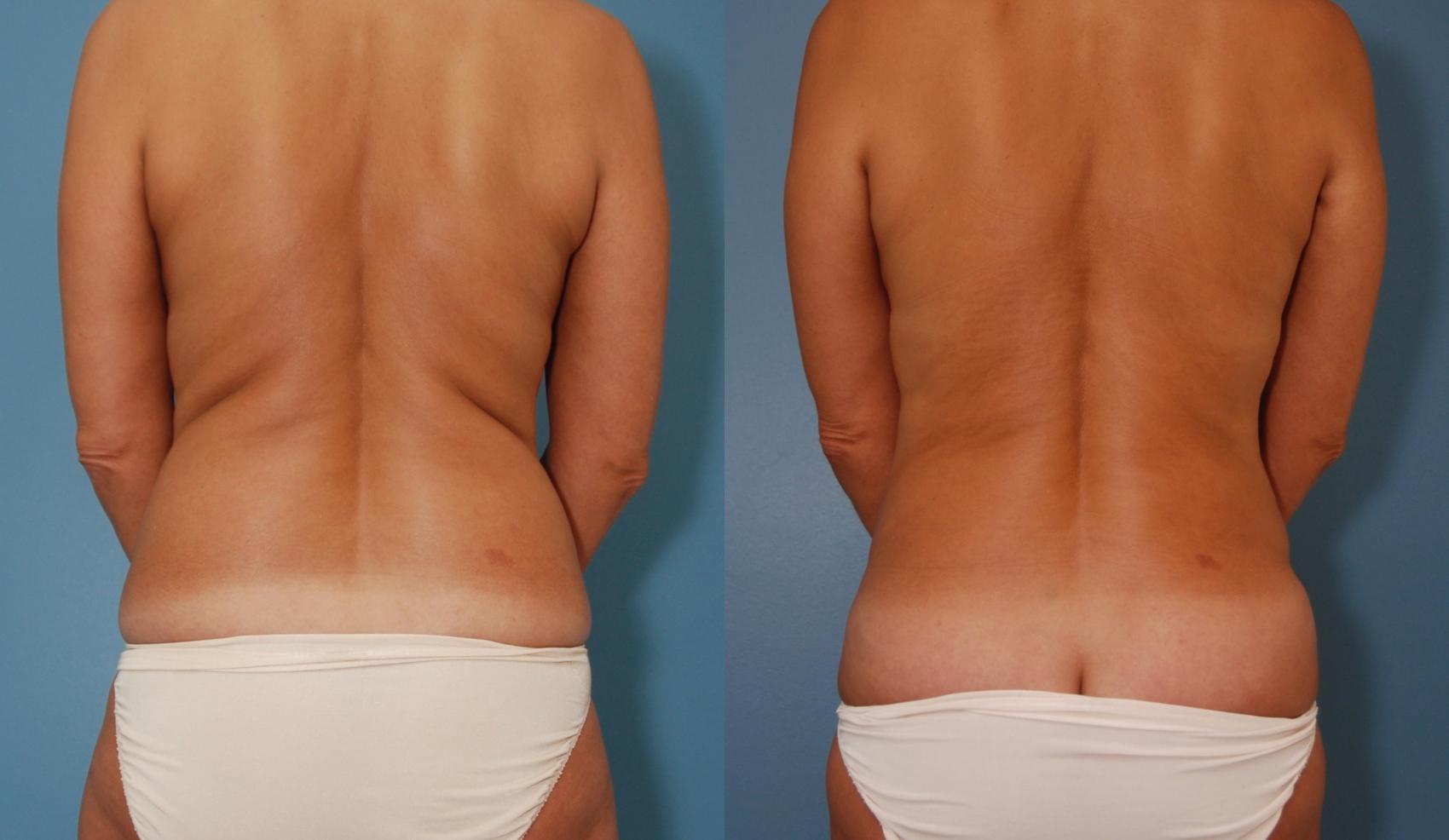 Before & After Liposuction Case 205 View #1 View in Toronto, ON