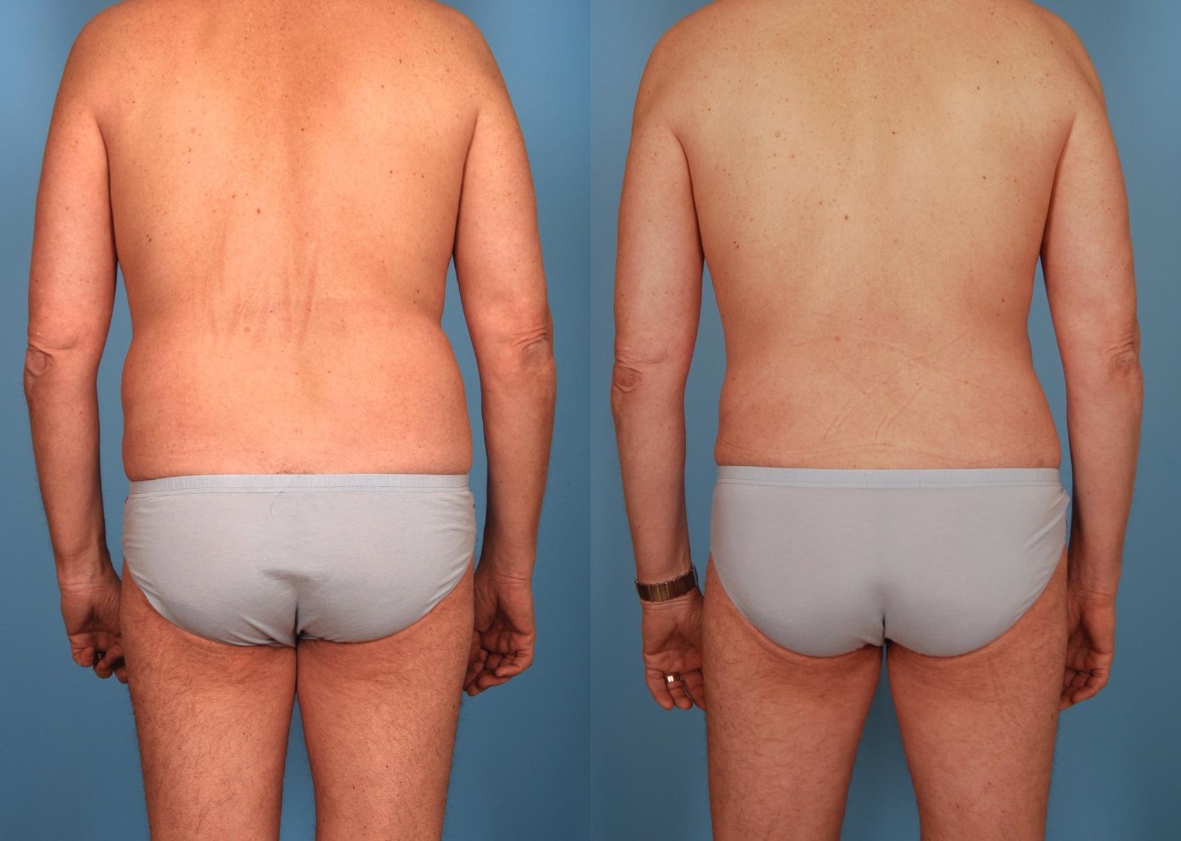Before & After Liposuction Case 206 View #1 View in Toronto, ON