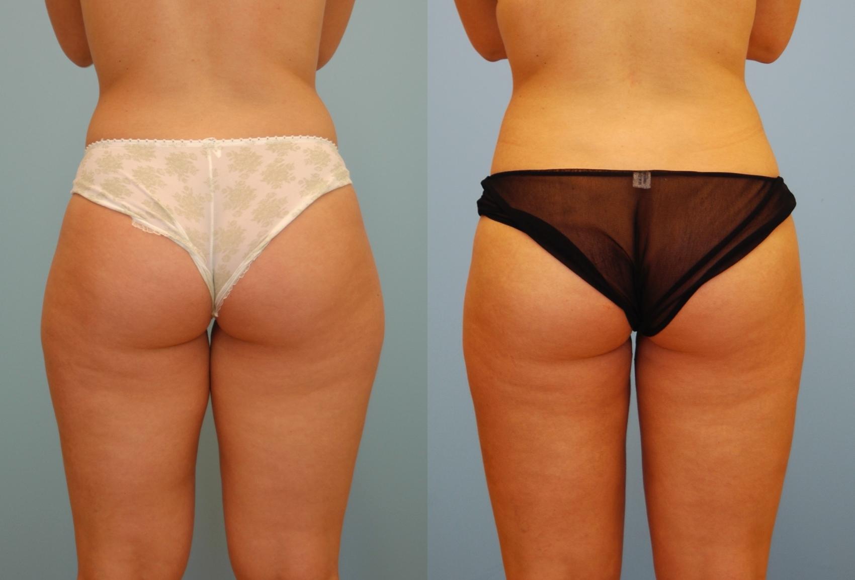 Before & After Liposuction Case 207 View #1 View in Toronto, ON