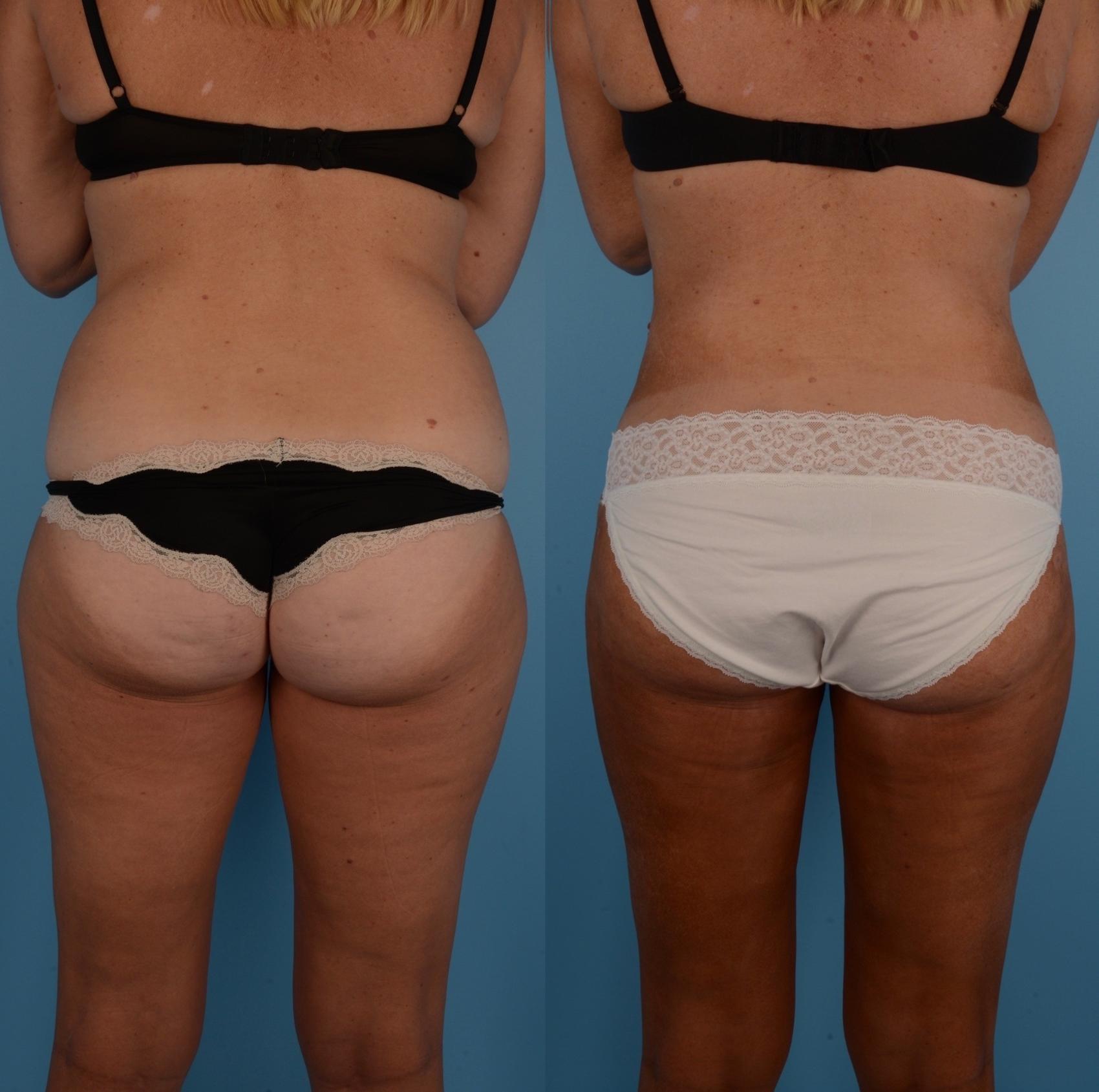 Before & After Liposuction Case 286 Back View in Toronto, ON