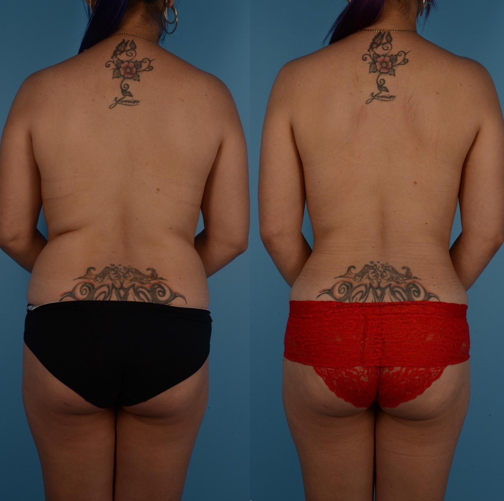 Before & After Liposuction Case 287 Back View in Toronto, ON