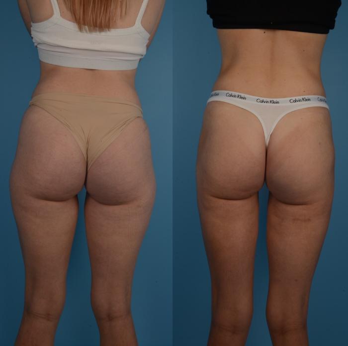 Before & After Liposuction Case 288 Back View in Toronto, ON