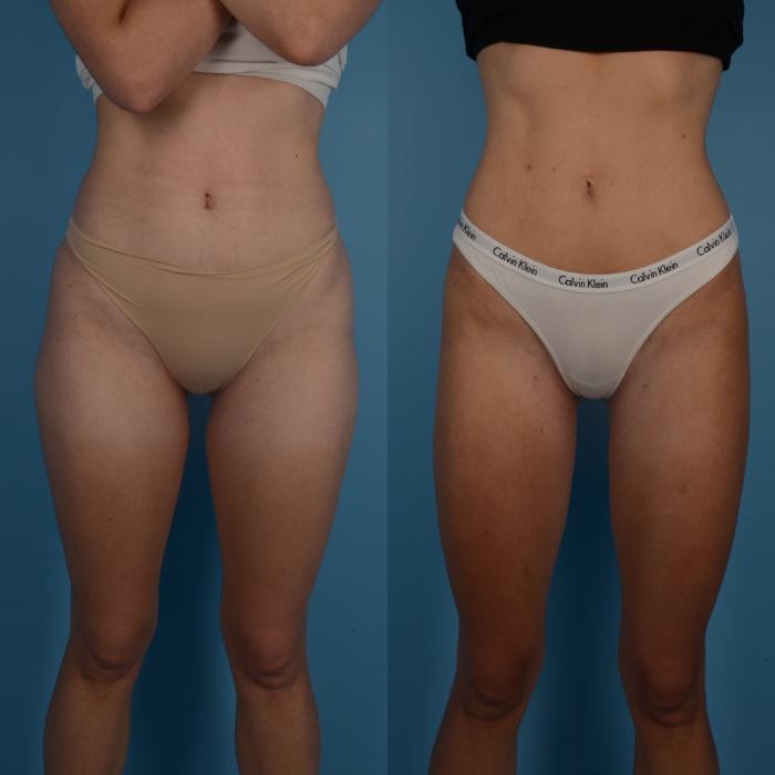 Before & After Liposuction Case 288 Front View in Toronto, ON